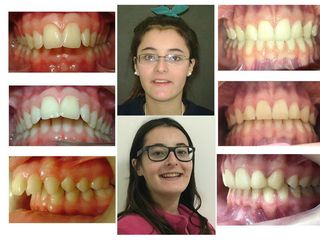 Ortodoncia - antes y después
