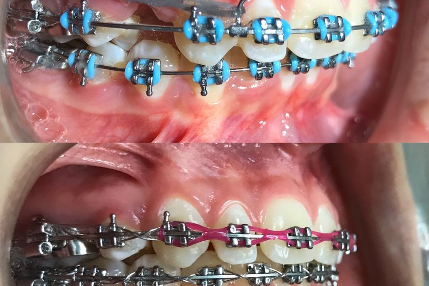 Implantes dentales antes y después - 646715