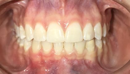 ortodoncia finalizada! 