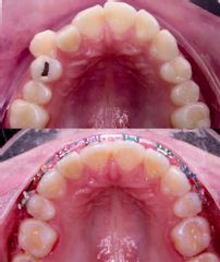 Inicial y casi final tratamiento de ortodoncia 