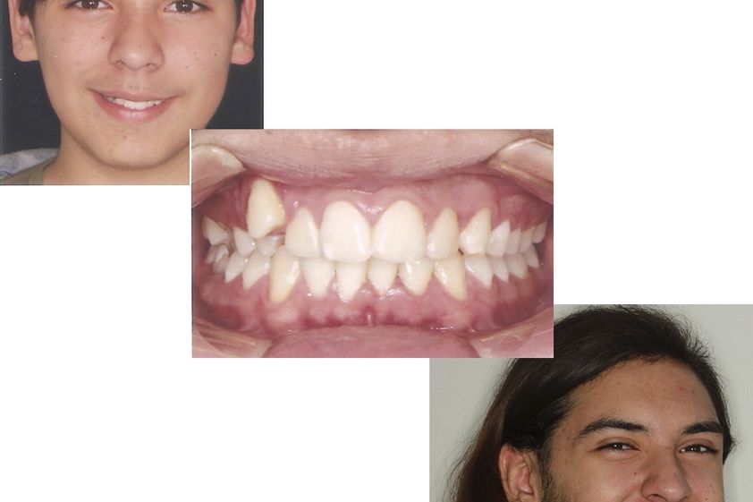 Ortodoncia antes y después - 790385
