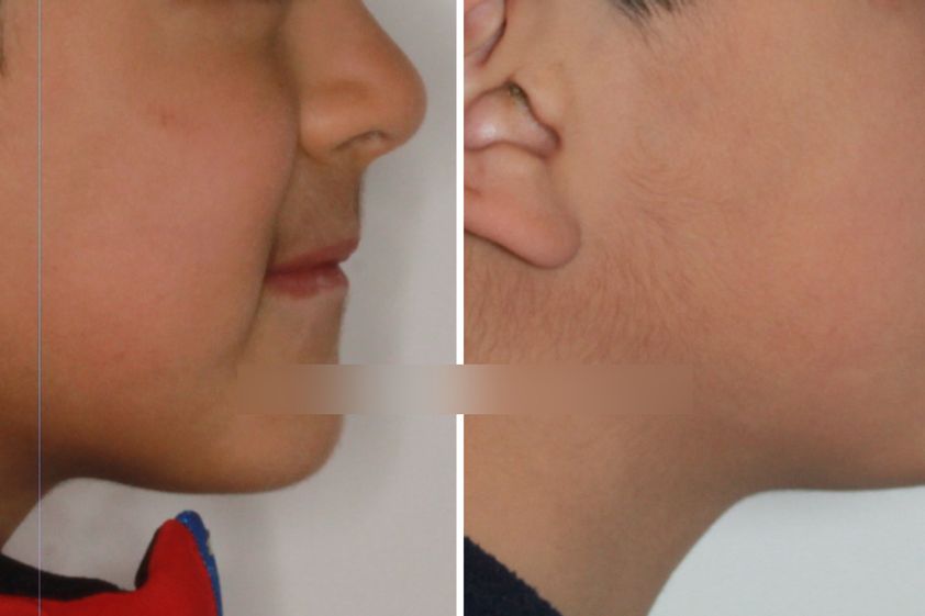 Cirugía maxilofacial antes y después - 839584