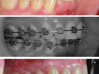 Ortodoncia antes y después - 860198