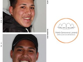 Ortodoncia antes y después - 860200