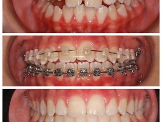 Ortodoncia antes y después - 860202