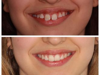 Ortodoncia antes y después - 860203