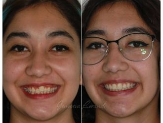 Ortodoncia antes y después - 860204