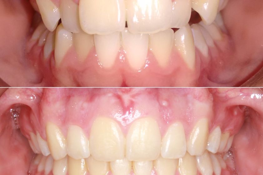 Ortodoncia antes y después - 879431