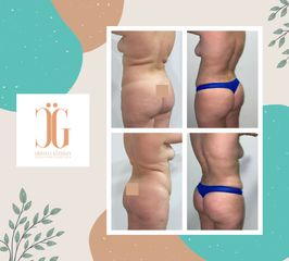 Liposucción - Dr. Cristian Gänsslen