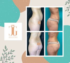 Liposucción - Dr. Cristian Gänsslen