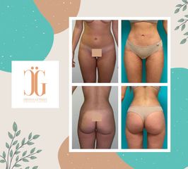 Liposucción - Dr. Cristian Gänsslen