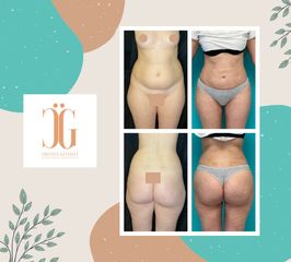 Liposucción - Dr. Cristian Gänsslen