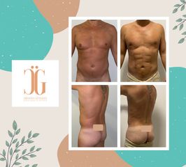 Liposucción - Dr. Cristian Gänsslen