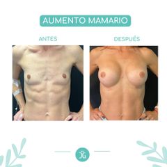 Aumento mamas - Dr. Cristian Gänsslen
