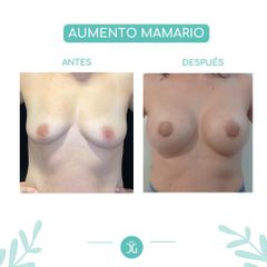 Aumento mamas - Dr. Cristian Gänsslen