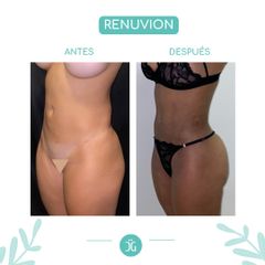 Liposucción - Dr. Cristian Gänsslen