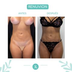 Liposucción - Dr. Cristian Gänsslen