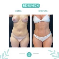 Liposucción - Dr. Cristian Gänsslen