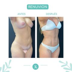 Liposucción - Dr. Cristian Gänsslen