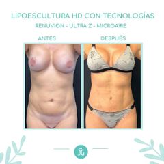 Lipoescultura - Dr. Cristian Gänsslen
