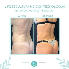 Lipoescultura - Dr. Cristian Gänsslen
