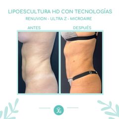 Lipoescultura - Dr. Cristian Gänsslen