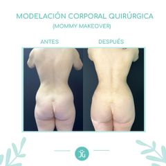 Liposucción - Dr. Cristian Gänsslen