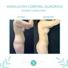 Liposucción - Dr. Cristian Gänsslen