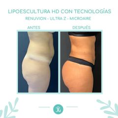Lipoescultura - Dr. Cristian Gänsslen