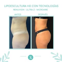 Lipoescultura - Dr. Cristian Gänsslen