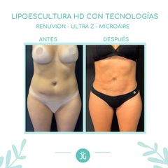 Lipoescultura - Dr. Cristian Gänsslen