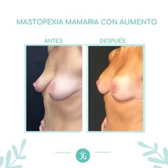 Mastopexia - Dr. Cristian Gänsslen