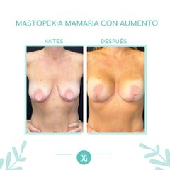 Mastopexia - Dr. Cristian Gänsslen