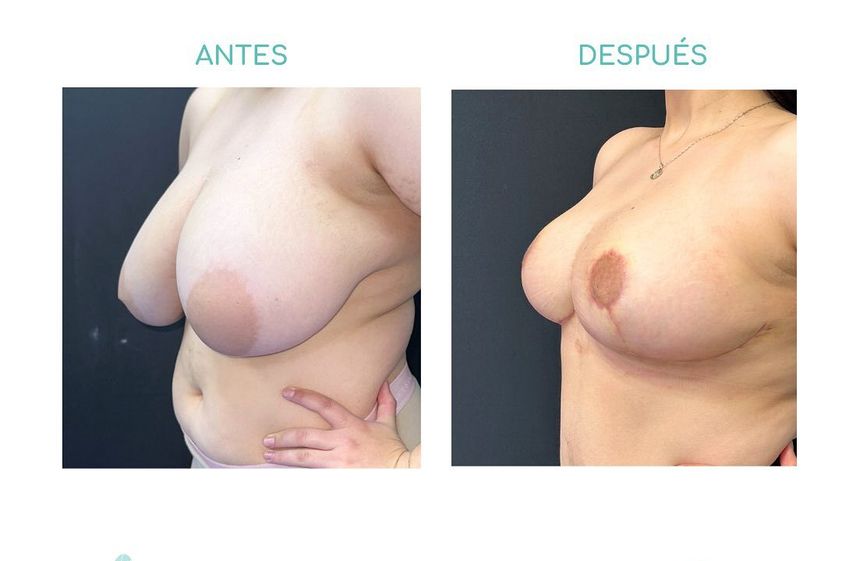 Reducción de mamas antes y después - 865647