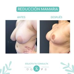 Reducción Mamaria - Dr. Cristian Gansslen