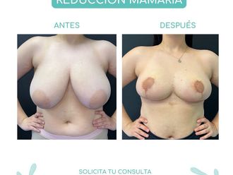 Reducción de mamas antes y después - 865648