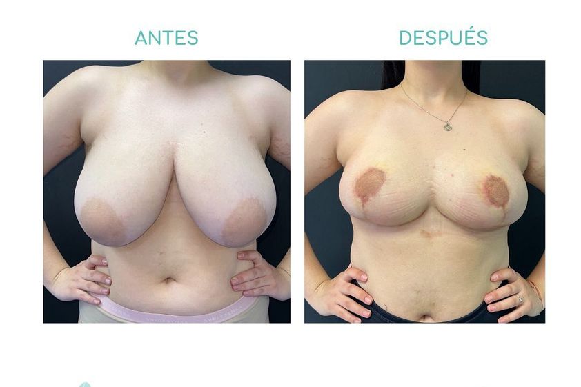 Reducción de mamas antes y después - 865648