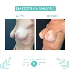 Mastopexia Mamaria - Dr. Cristian Gansslen