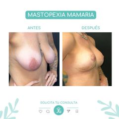 Mastopexia Mamaria  - Dr. Cristian Gansslen