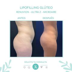 Lipofilling Glúteo - Dr. Cristian Gansslen