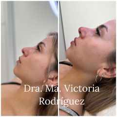 Rinomodelación  - Dra. María Victoria Rodríguez