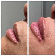 Relleno de labios - Dra. María Victoria Rodríguez