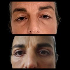 Blefaroplastia - Dra. Maria Victoria Rodriguez