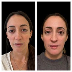 Blefaroplastia - Dra. María Victoria Rodríguez