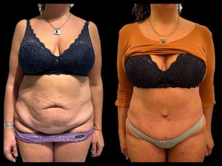 Abdominoplastia - Dra. María Victoria Rodríguez