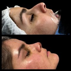 Rinoplastia - Dra. María Victoria Rodríguez