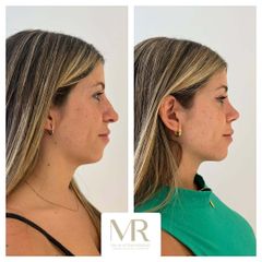 Rinoplastia - Dra. Maria Victoria Rodriguez