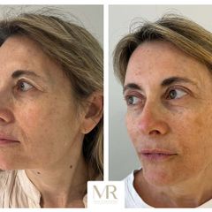 Blefaroplastia superior - Dra. Maria Victoria Rodriguez