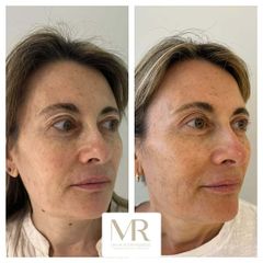 Blefaroplastia superior - Dra. Maria Victoria Rodriguez