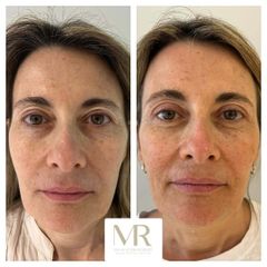 Blefaroplastia superior - Dra. Maria Victoria Rodriguez